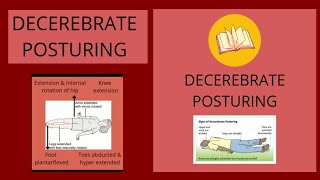 Decerebrate Vs Decorticate Posturing [upl. by Llovera]