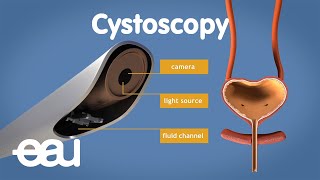 Cystoscopy overactive bladder [upl. by Allehcim]