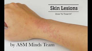 Skin lesions part 1Benign and Premalignant by ASM Minds Team [upl. by Giarla]