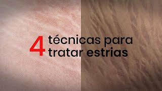 4 técnicas para tratar estrias [upl. by Valda]