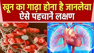 Blood के गाढ़ा होने से Health को होते है गंभीर नुकसान जानिए लक्षण और ब्लड पतला करने के उपाय [upl. by Pradeep413]