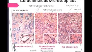 Carcinoma de mama descripción patológica [upl. by Ailices44]