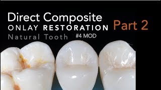 Direct Composite Onlay Part 2 Restoration  4 MOD Natural Tooth [upl. by Eedia]