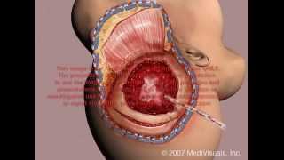 Craniotomy Surgery [upl. by Morey351]