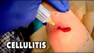 ABSCESS WITH CELLULITIS We had to drain it  Dr Paul [upl. by Ellinej619]