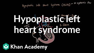 Hypoplastic left heart syndrome and norwood glenn fontan  NCLEXRN  Khan Academy [upl. by Arissa]