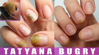 How I Cured My Nails  Shocking Experience  Restoring Nails from Bacteria [upl. by Nerfe]