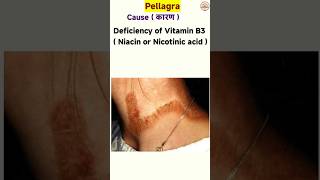 pellagra disease  niacin deficiency disease  skin diseases [upl. by Tomlin77]