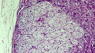 Wart vs Squamous Cell Carcinoma Dermpath Pathology Dermatology Verruca Seborrheic Keratosis SCC [upl. by Celeste]