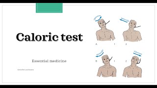 Caloric test Essential medicine [upl. by Partan]