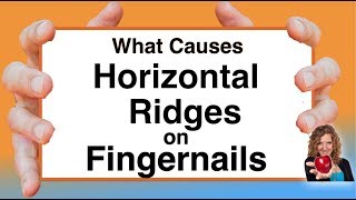 What Causes Horizontal Ridges on Nails With Karen Langston [upl. by Phillips]