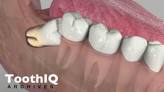 Impacted Tooth Removal [upl. by Retse350]