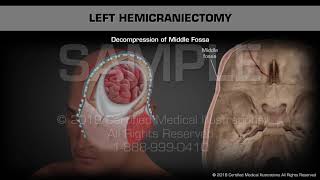 Left Hemicraniectomy  Medical Animation [upl. by Richmound]