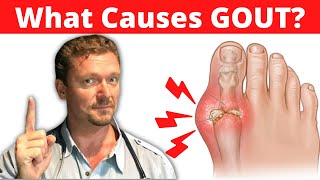 What Causes GOUT Meat Doesnt Cause Gout 2024 [upl. by Perzan913]