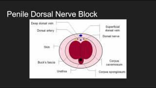 NYSORA Regional Anesthesia Interscalene Block [upl. by Nirrol]