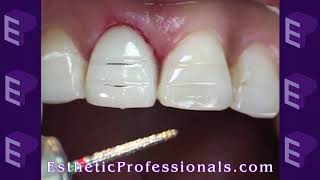 Porcelain Veneers Preparation Techniques 1 [upl. by Haisa]