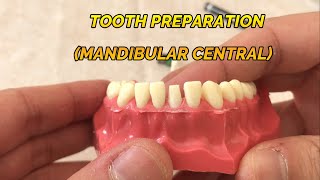 CROWN PREPARATION TUTORIAL MANDIBULAR CENTRAL [upl. by Assirol]