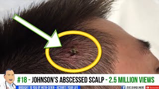 Abscessed Scalp Johnsons Infected Scalp Abscess [upl. by Luba]