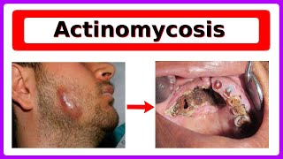 actinomycosis [upl. by Legnaros316]