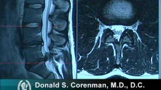 How to Read a MRI of a Lumbar Herniated Disc  Lower Back Pain  Colorado Spine Surgeon [upl. by Eibreh114]