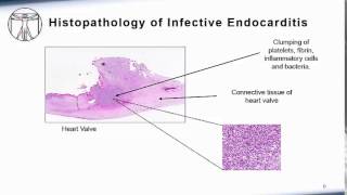 Endocarditis Pathophysiology [upl. by Adrienne]