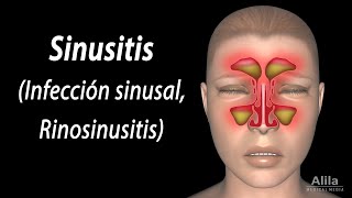 Sinusitis Animación Alila Medical Media Español [upl. by Conte511]