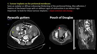 Imaging in Peritoneal Carcinomatosis [upl. by Docilla]