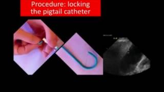 Ultrasound Guided Drainage of the Gallbladder [upl. by Annaitsirk]