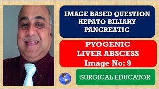 PYOGENIC LIVER ABSCESS Hepato Biliary Pancreatic Image 9 [upl. by Aiepoissac]