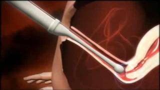 3D animation of how IVF works [upl. by Schouten189]