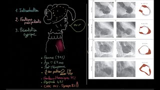 Cardiomyopathie de Takotsubo  Docteur Synapse [upl. by Kellene]