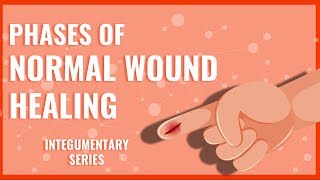 Tunneling and Undermining  Wound Care Demonstration [upl. by Eiramana]