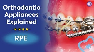 Orthodontic Appliances Explained  RPE [upl. by Enial]