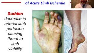 Acute Ischemia  OVERVIEW [upl. by Chev]