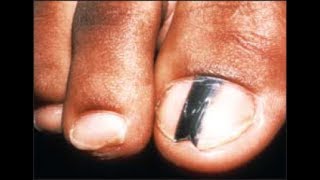 Are Black Toenail Lines amp Streaks Safe Doctor Treatment [upl. by Laroy447]