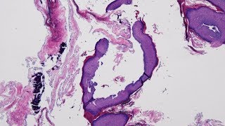 What is Hyperplasia  Pathology mini tutorial [upl. by Kistner]