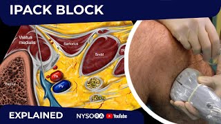 Ultrasound Guided Axillary Brachial Plexus Block NYSORA Regional Anesthesia [upl. by Aikcir]