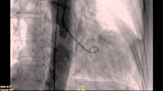 Takotsubo Cardiomyopathy [upl. by Dorcus]