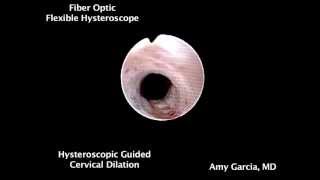 Hysteroscopicguided cervical dilation [upl. by Hael192]