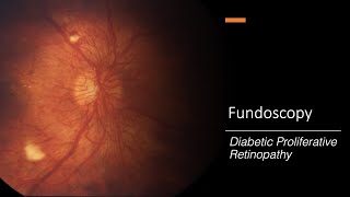 Diabetic Proliferative Retinopathy Fundoscopy [upl. by Adnuhser]