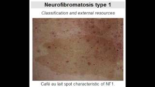 Neurofibromatosis Type 1 von Recklinghausens Disease [upl. by Bolan]