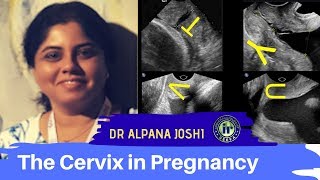 TMT The Cervix in Pregnancy by Dr Alpana Joshi [upl. by Clarinda429]