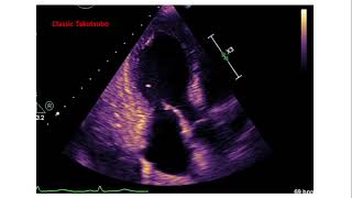 Takotsubo Cardiomyopathy broken heart syndrome [upl. by Hesler]