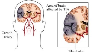 Transient Ischemic Attack TIA [upl. by Ahsinel535]