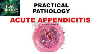 ACUTE APPENDICITIS Etiopathogenesis clinical features amp morphology [upl. by Pippy]