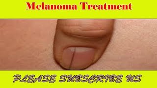 Black Line ON Nail Melanoma Treatment  Malignant Melanoma  Prevention Tips and Treatment Methods [upl. by Sumner]