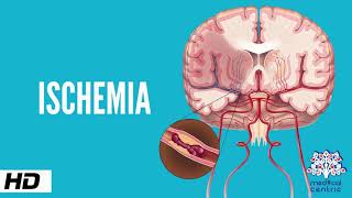 Ischemia Causes Signs and Symptoms Diagnosis and Treatment [upl. by Atekal668]