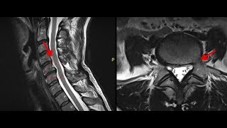 Bulging Discs Causes and Treatment [upl. by Hakan]