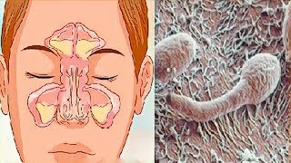 ¿Nariz obstruida rinitis o sinusitis Sepa cómo resolver [upl. by Sairacaz]