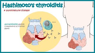 Hashimotos thyroiditis  Autoimmune diseases [upl. by Gamages]